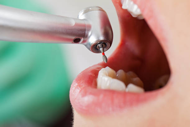 Best Emergency Dental Care for Broken or Chipped Teeth in Dresden, OH
